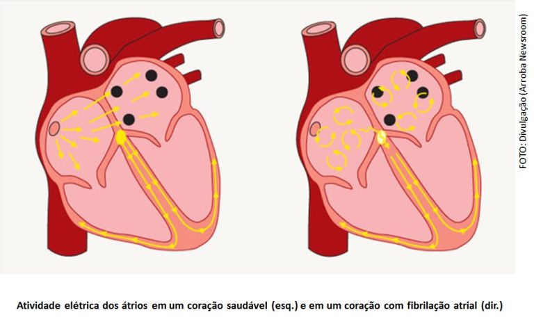 Fibrilação atrial causa risco de AVC e outras doenças